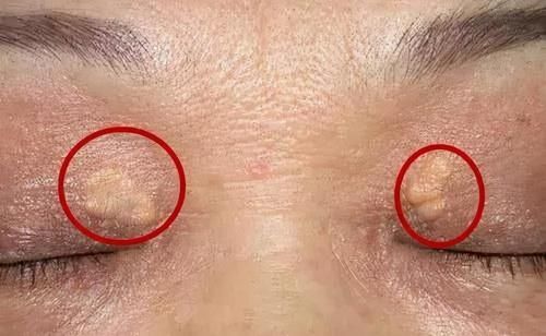 高血脂|“溶栓高手”公布,并非苦瓜,平时敞开吃,血管干净,远离头晕手麻