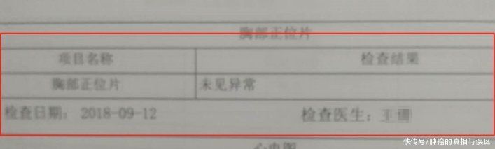 筛查|体检一切正常，一个月后癌症晚期？别再做4种“假体检”