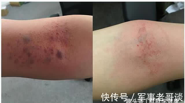 排痰|秋天是身体排痰的好季节,这样做养肺排痰,清除体内垃圾!