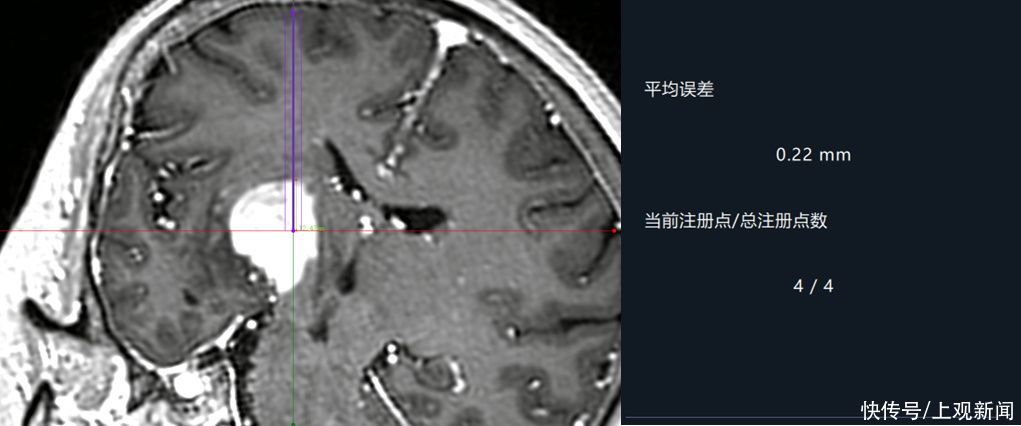 刘强强|不开颅，脑内占位病变怎样确诊？