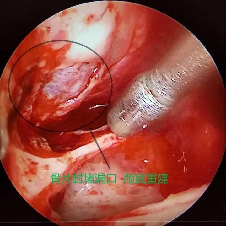 鼻内镜|流“鼻涕”一个多月,竟是脑脊液!鼻内镜下脑脊液修补术解难题