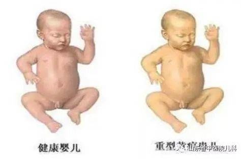 推荐：新生儿黄疸的护理