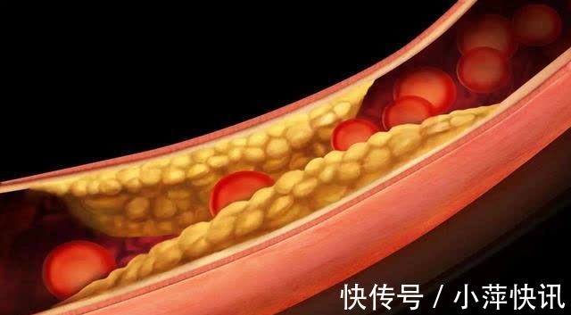 耳垂|血脂偏高的人,头部或有4个表现,若想调节血脂,给你2个小建议