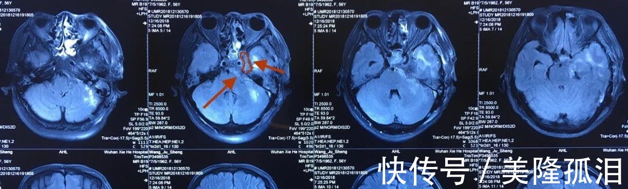 磁体|为什么“磁共振”尽量不要做或许你还不明白,与这3点有关系
