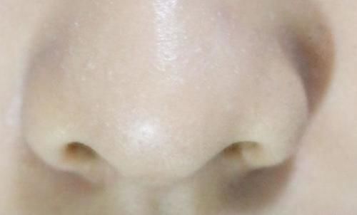 鼻子两侧挤出来的白色条状物，是什么东西？真的会越挤越多吗？