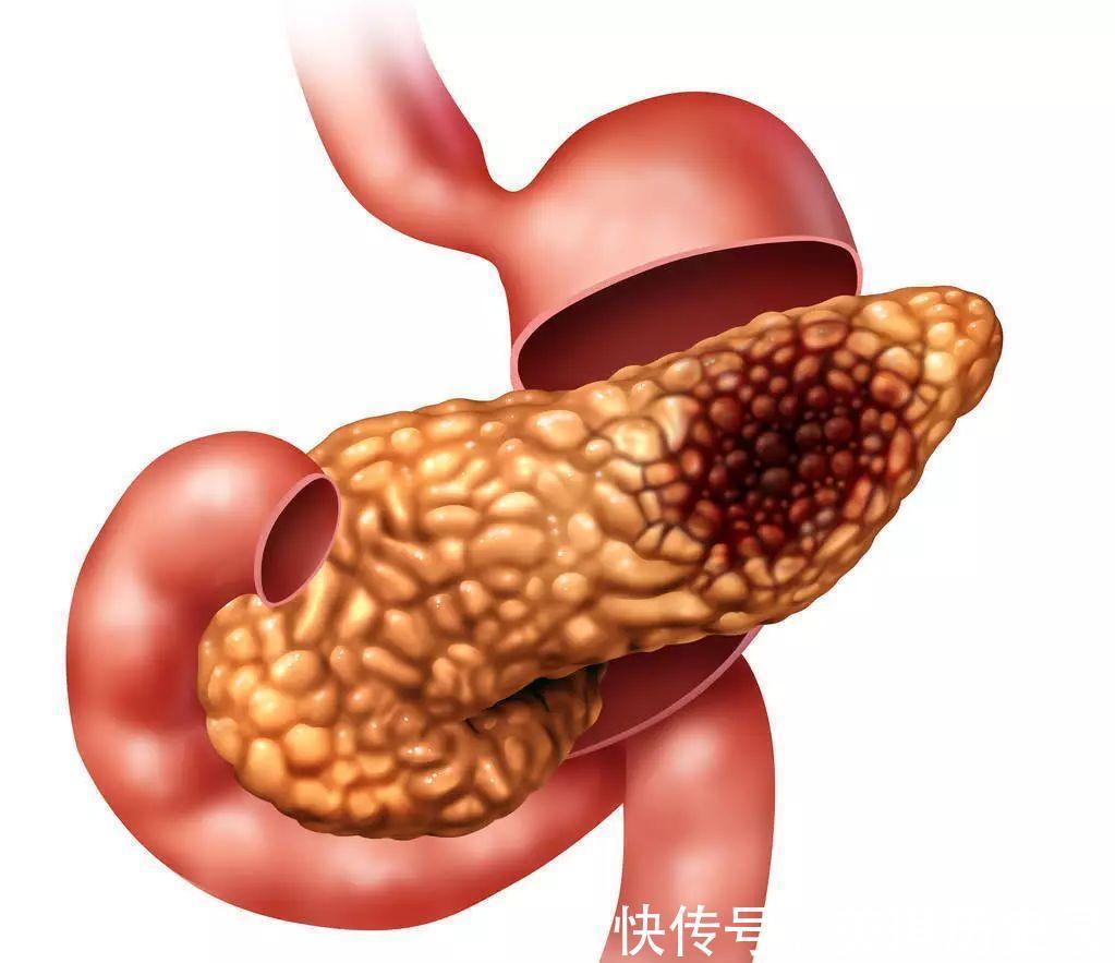胰腺囊肿|胰腺癌为何发现多为晚期?高危人群有哪些?跟糖尿病有关系?