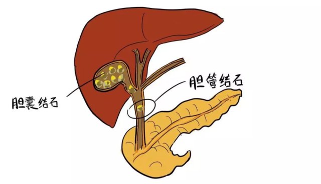 胆囊癌|经常饿一顿会引发胆结石！还有更严重的事……这5类人群可要当心了