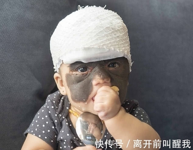 面具|7个月婴儿脸上因巨大黑色胎记爆红!像带着“蝙蝠侠”面具!