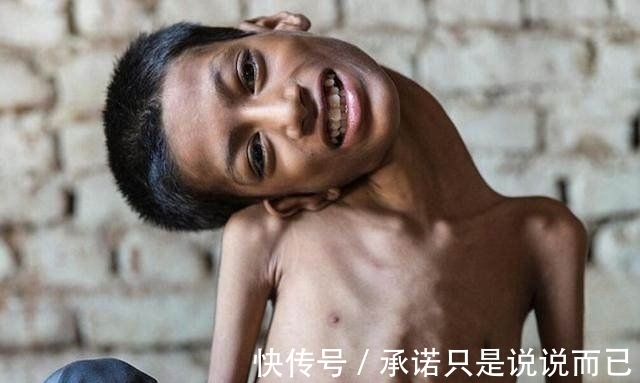 利瓦|男孩头部怪异,只能挂在胸前,手术7个月后的模样让人感动到哭!