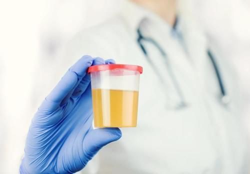 糖尿病|小便后泡沫多,是得了糖尿病肾病吗?这篇文章说清楚了