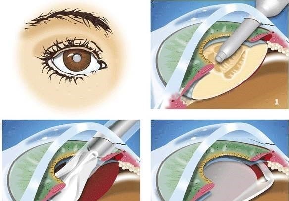 手术|高度近视人群的摘镜优选ICL晶体植入术“过人之处”你知道吗