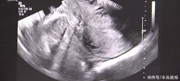 王女士|罕见!女子宫内宫外同时受孕 鬼门关外走一遭