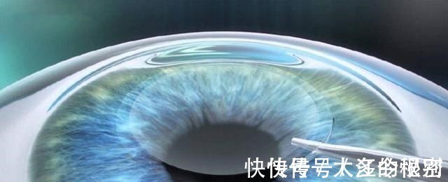 激光近视手术|那些做了激光近视手术的人, 后来怎么样了 来听听过来人怎么说!