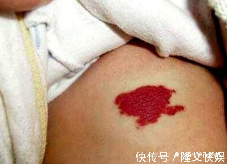 血管瘤|越来越多胎儿被“胎记”缠身,若不想孩子自卑,孕妈要管住自己