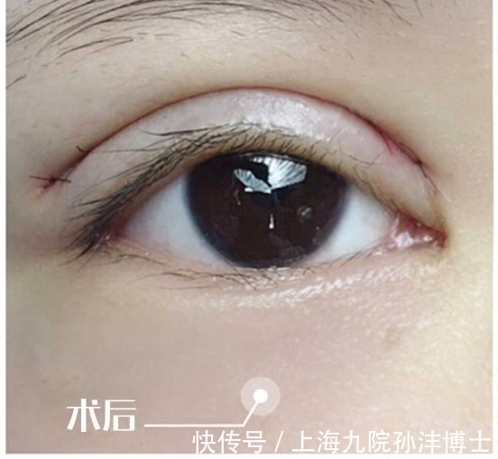 手术 眼修复孙沣博士:双眼皮术后是否会产生疤痕和增生?