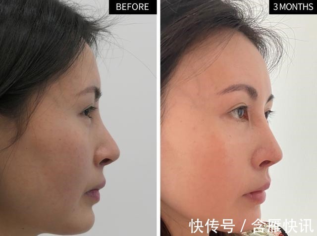 泪沟 求美者很想撤回的照片,真实记录泪沟、鼻修复术后3个月效果变化!