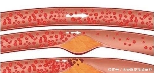 血脂|血栓天敌被发现了，每天吃2口，清血管冲走血栓，杜绝高血脂