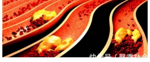 血液循环|多走路可以降血脂？心血管医生：过了50岁，做好3件事更有效果