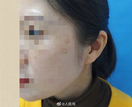 90后女孩熬夜10年长出老年斑！新研究表明“夜猫子”更容易患抑郁症