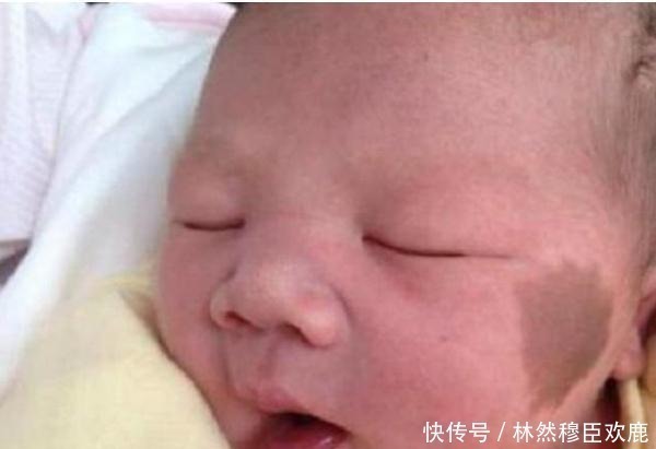 小鸿儿|胎记咋来的产科医生除了遗传,还与孕期的这3种行为有关