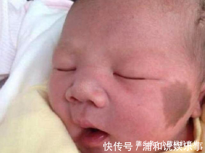 产科医生|胎记是怎么来的?妇科医生:除了遗传,孕期尽量避开这3种行为