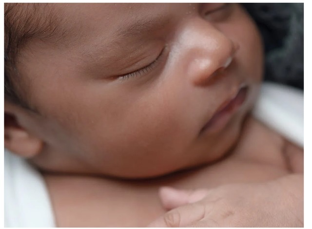 水肿|医院“黑脸宝宝”走红,妈妈忍住“没扔”,2月后完美逆袭