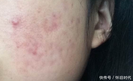 在这个看脸的社会,不注意这些,小心痘印“毁容”
