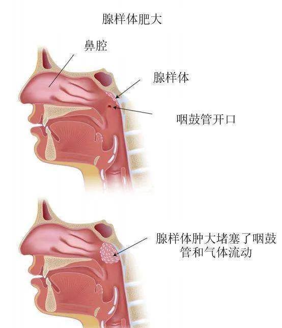 睡眠呼吸暂停|别让漂亮的孩子变成“丑小鸭”——腺样体肥大影响孩子的容貌