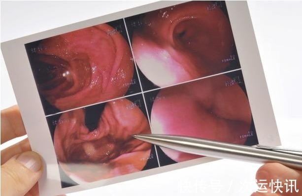 胃病|胃开始癌变,身体会出现“3多2臭”,若1个没占,胃部还算健康