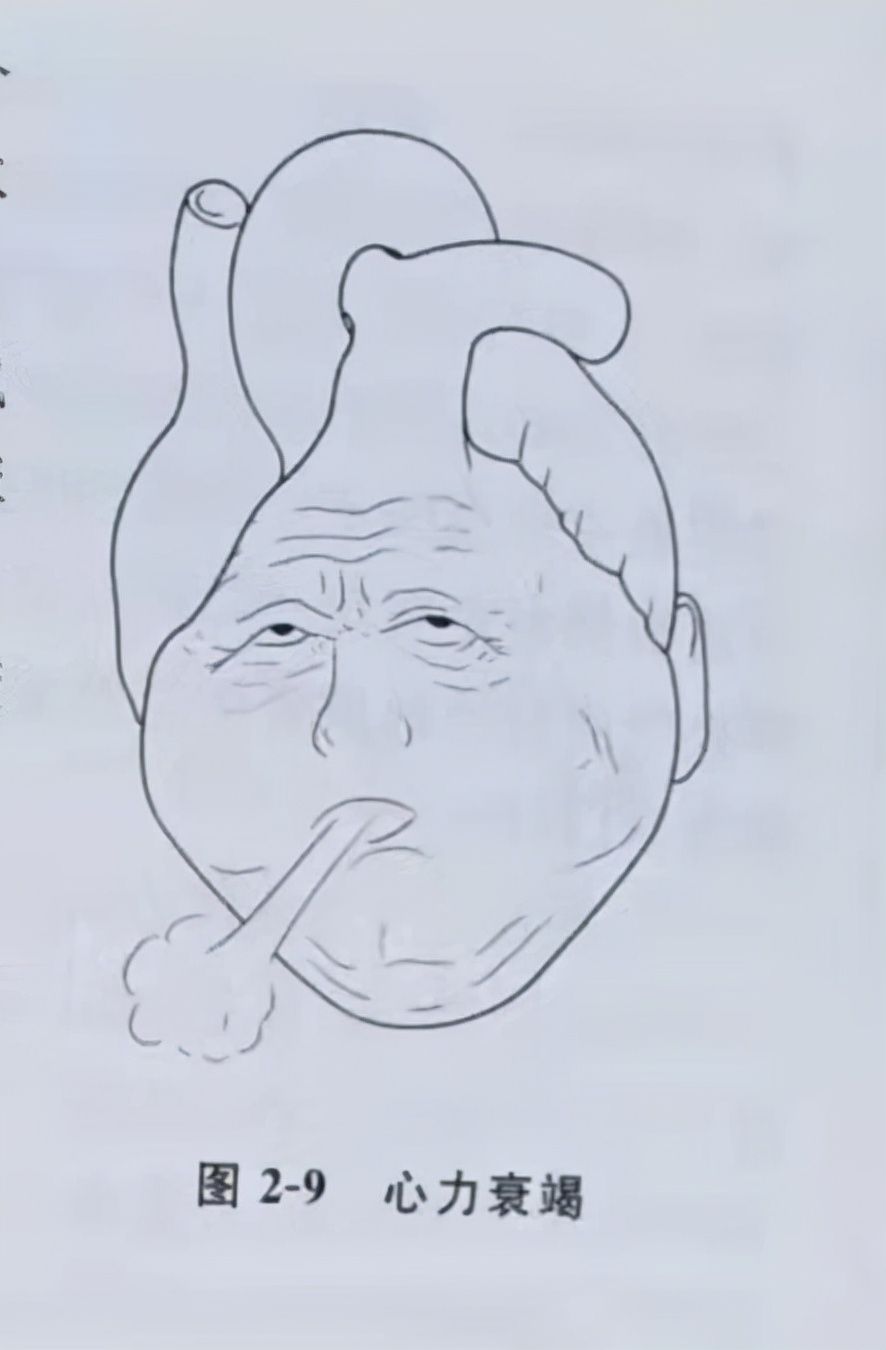 心力衰竭|科普:何为心力衰竭和心功能不全?两种疾病哪个对人的危害更大?