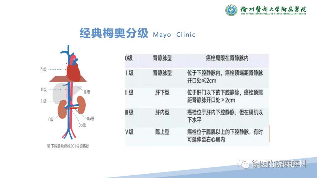 下腔静脉|肾癌伴下腔静脉癌栓患者的麻醉管理——早课学习