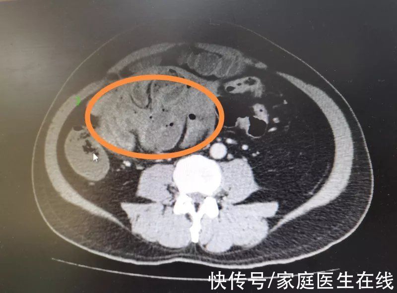 腹茧症|59岁大叔反复腹痛，以为是腹泻，却不知道肚子竟长了巨大“蚕茧”