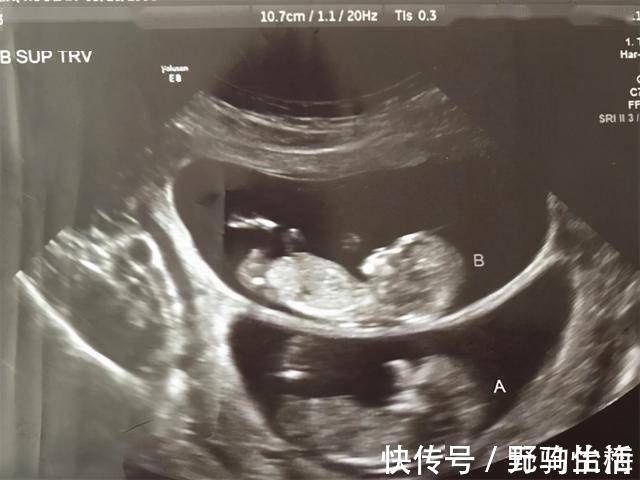 测量|孕妇做B超时,医生总是说胎儿比实际天数多几天是为什么?