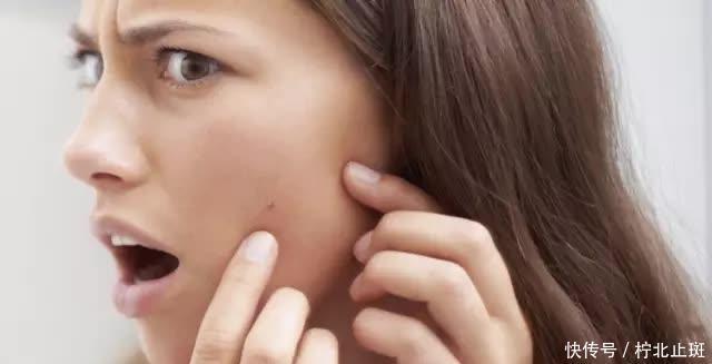 换季式变丑!皮肤爆痘又脱皮,来试试做这3件事“自救”