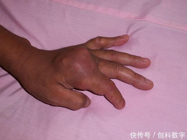 痛风|降尿酸“高手”藏在厨房，平时这样吃，尿酸降下来，痛风不见了