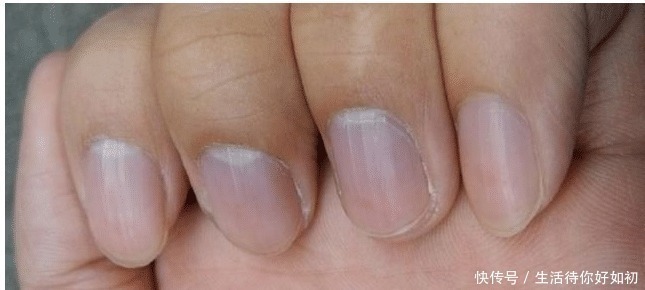 遗传|手指甲出现“竖纹”, 多半和这3个“情况”有关, 看完或许会明白!