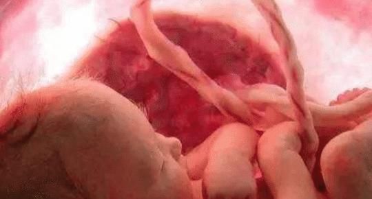 宝宝|产检没问题却生下畸形儿医生以下几种情况,四维彩超也看不出