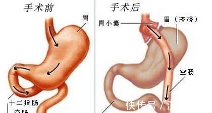 胃转流手术|糖尿病必须终身用药？关于糖尿病的十大谣言，咱们来好好驳斥