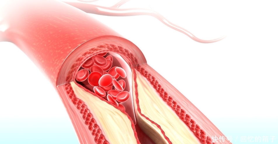预防冠心病的发生及进展,给所有三高和冠心病患者三点建议,收藏