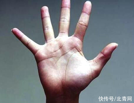 肝掌|体内有癌，手脚先知！医生提醒：手脚出现4种变化，千万不要拖