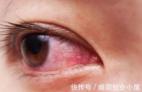 红血丝|眼睛出现这4种情况,可能是肝脏在向你求救,别不当回事!