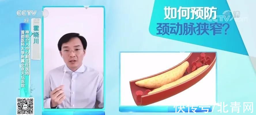 颈动脉斑块|它是最怕堵的一根血管，严重可致命！4种方法帮你预防