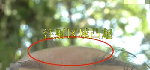 玻尿酸|玻尿酸注射一半,医生要求加3000再打一针?女子:把我当猪宰