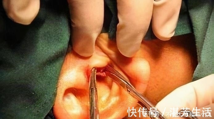 耳屎|孩子生下来就没掏过耳朵,又长又宽的耳屎堵住耳道,家长需警惕