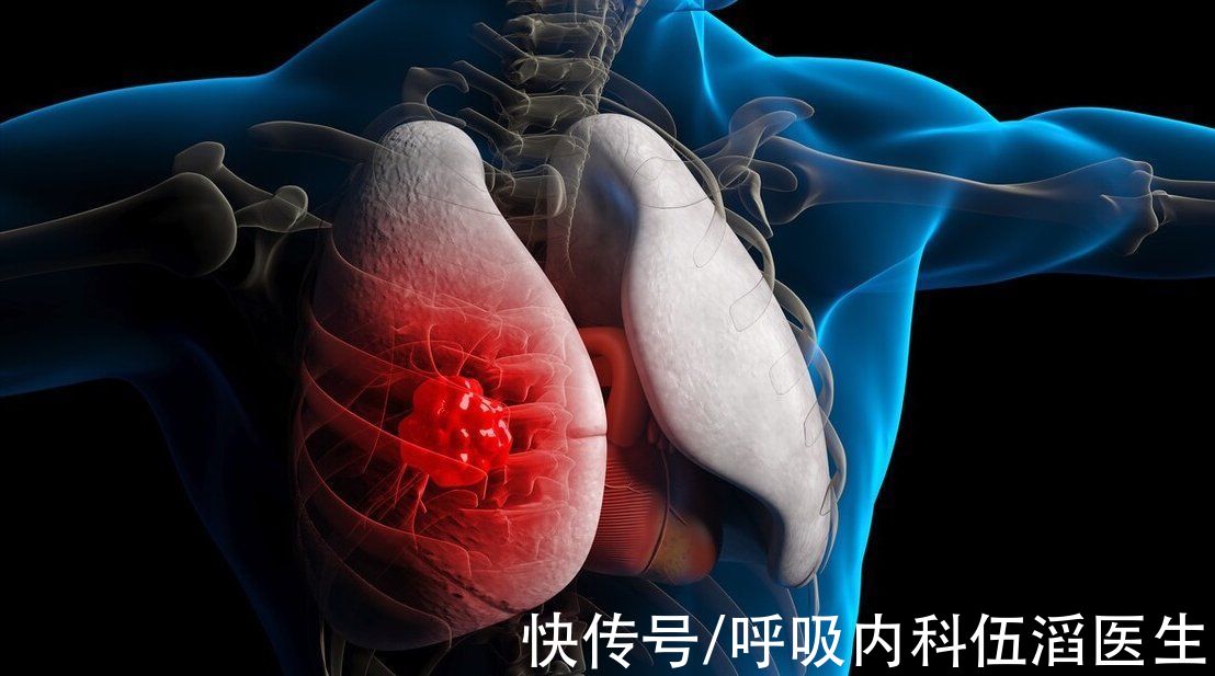 患癌|呼吸科医生提醒:这4类人易患上肺癌,要去做定期体检,排查病变