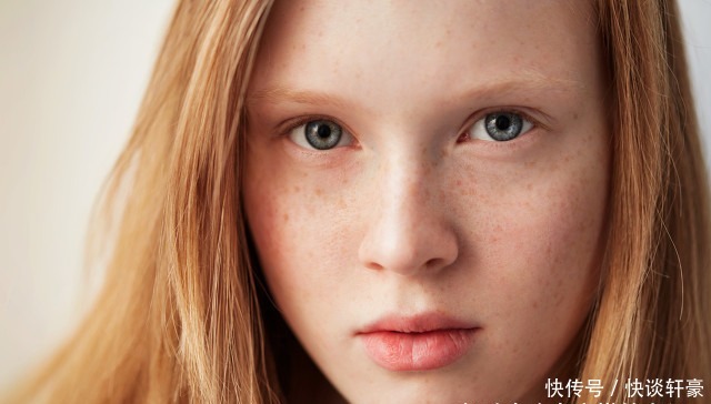 激光|困扰大多数人的色斑,到底用什么办法才能去除?