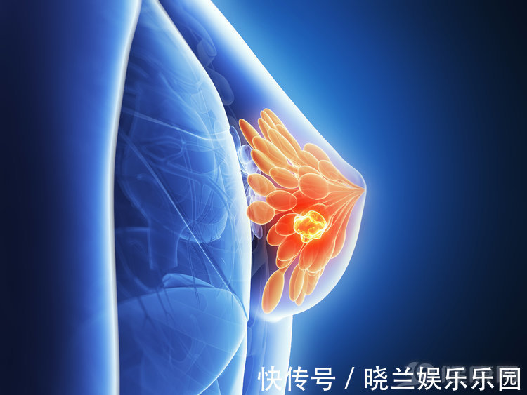 乳腺癌|不瞒你说:最难治愈的癌症中,这5种“榜上有名”