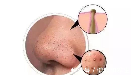 暗沉 秋冬护肤最容易忽略的步骤,少了它,皮肤容易暗沉粗糙、毛孔粗大!