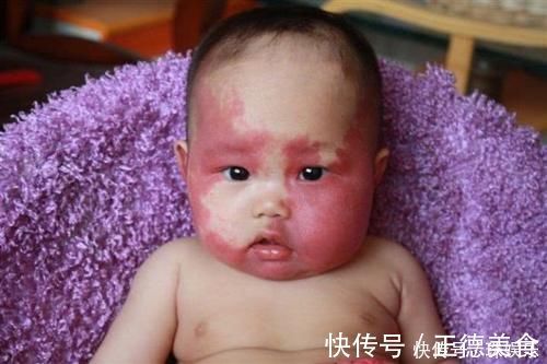 小张|孕期不经意的这几种行为,很容易让“胎记”找上宝宝,孕妈别大意