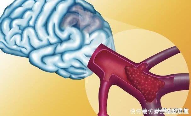 医生|25岁女孩突然间手麻,医生:这个决定救了她一命